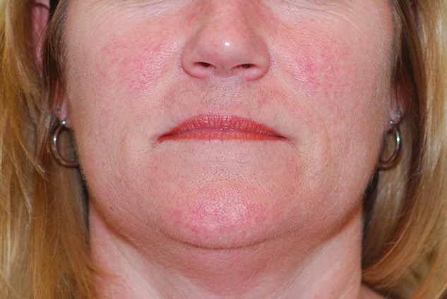 lafrance_laser-spot-removal_after - LaFrance - Medical ...