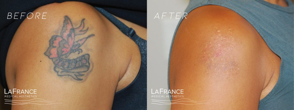 Tattoo removal for a new beginning! - LaFrance - Medical Aesthetics Clinic  In Central Connecticut